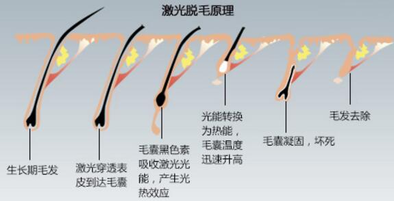 激光脱毛的效果能保持多久