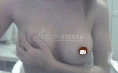 乳房下垂+乳头整形3.jpg