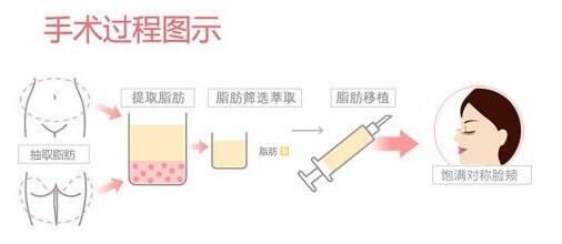 脂肪填充面部要多久恢复