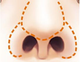 鼻翼缩小手术后呼吸不通畅怎么办
