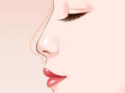 假体隆鼻修复要注意什么