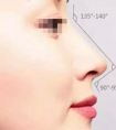 假体隆鼻的效果可以保持多少年