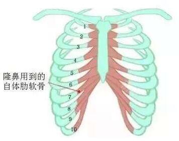 肋软骨隆鼻后遗症明显吗