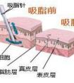 吸脂减肥费用大概是多少