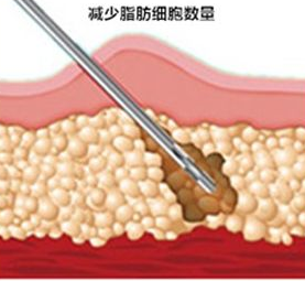 抽脂减肥前要做什么准备吗