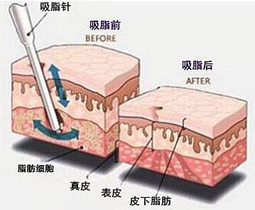 脸部吸脂要多少钱