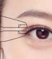 做切开双眼皮手术会有肿胀淤青问题出现吗