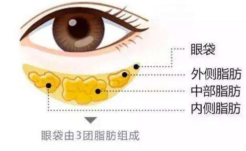 手术切除眼袋的价格贵不贵