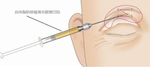 眼窝凹陷