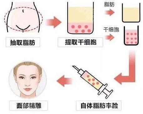 脂肪填充面部效果会受季节气候影响吗