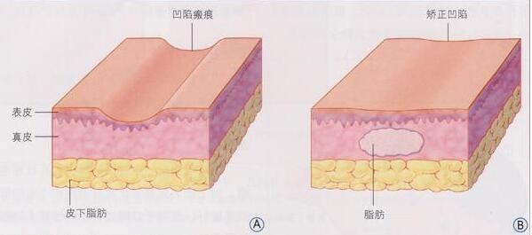 脂肪填充面部效果能保持多久